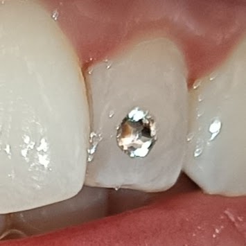 Applicazione Gemme Dentali Estetiche